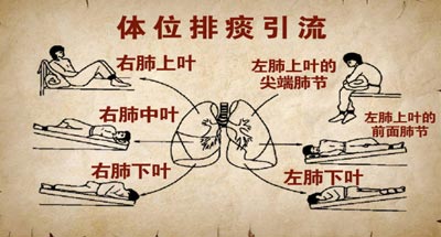 体位引流1.jpg