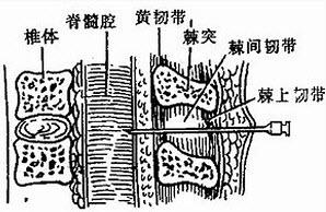 腰椎穿刺术3.jpg