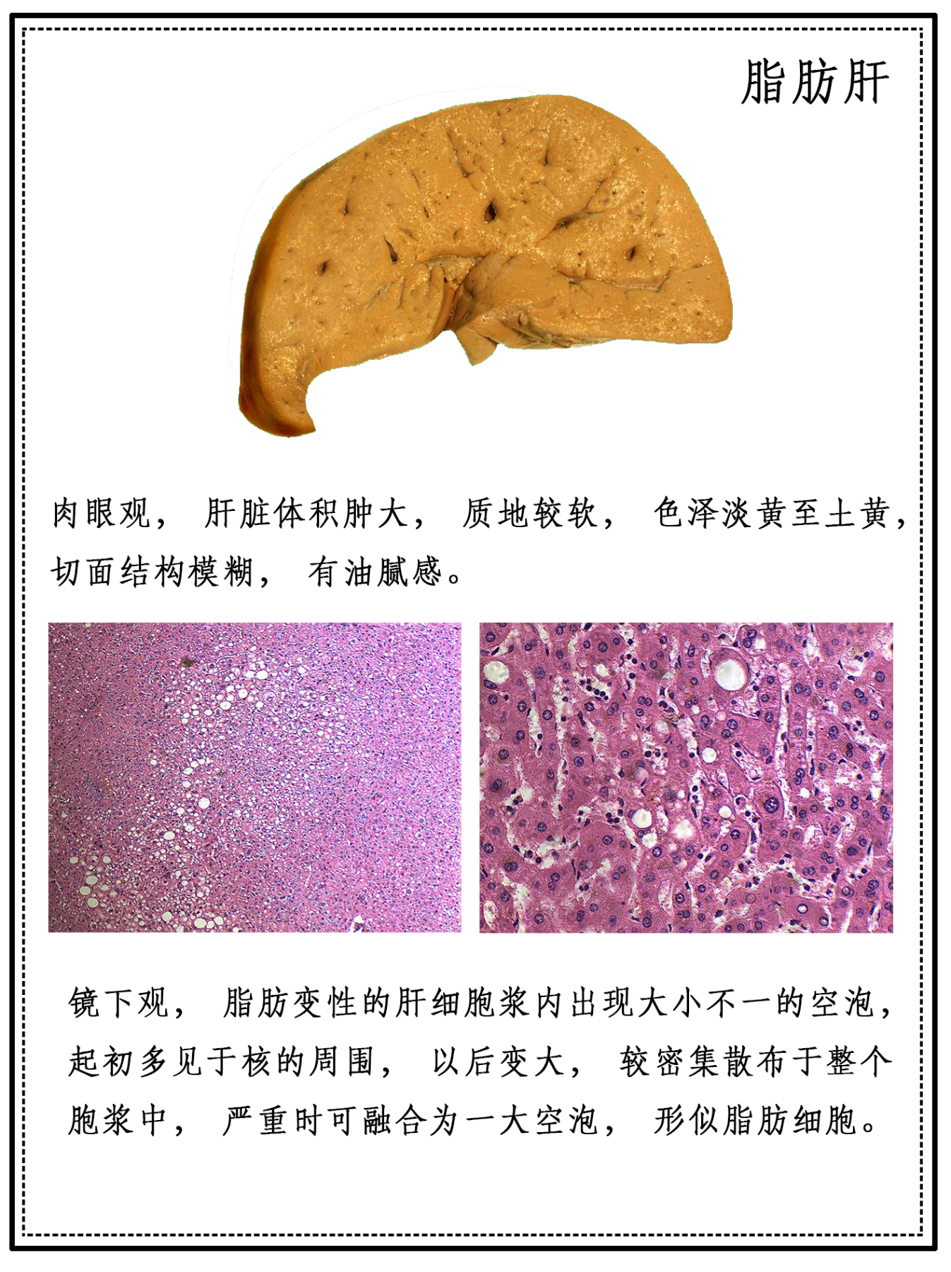 HL0201脂肪肝1.png