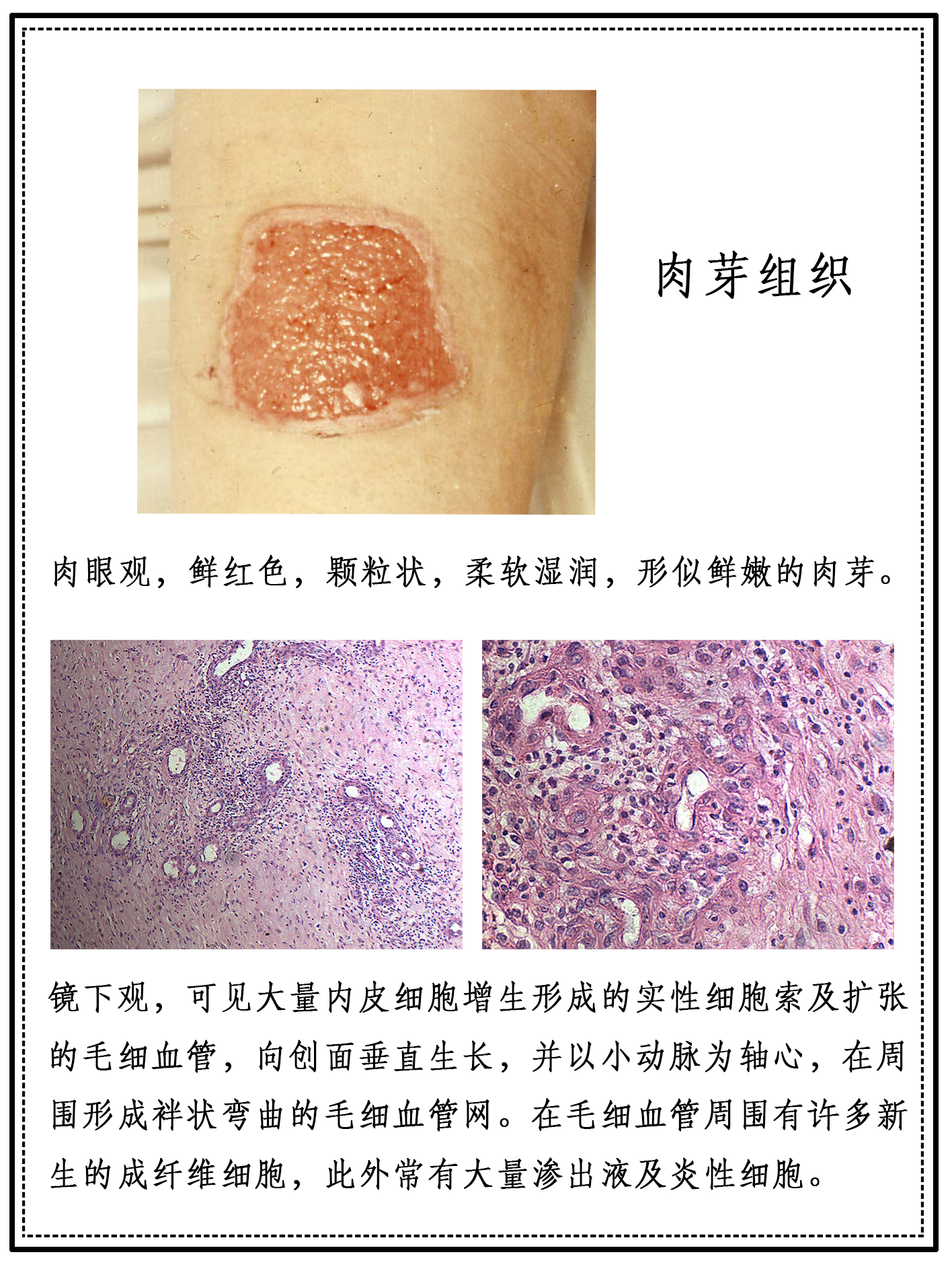 HL0203肉芽组织.png