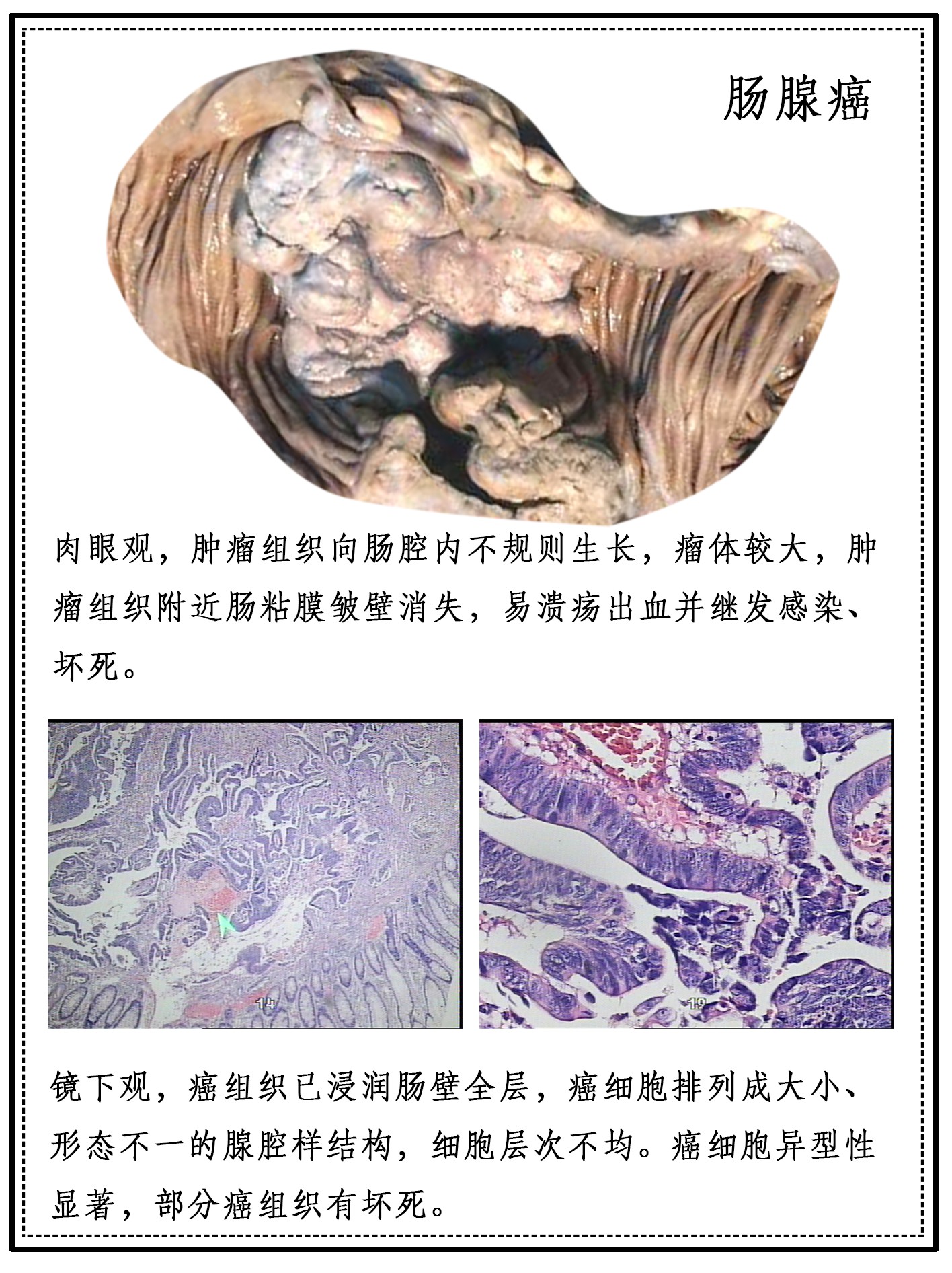 HL0503肠腺癌.jpg