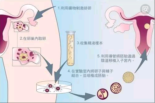 体外受精-胚胎移植（IVF-ET）示意图.png