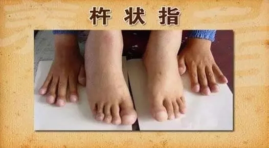 杵状指（趾）2.jpg