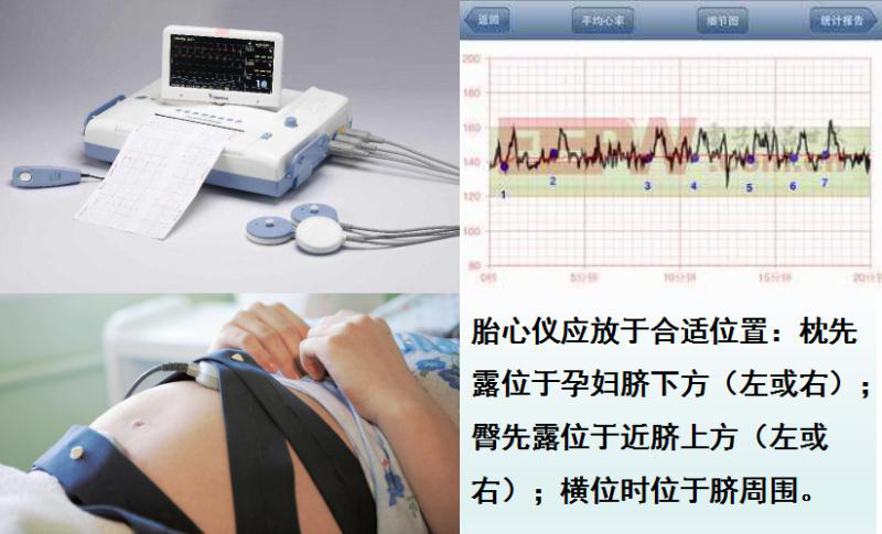 胎心仪放置位置.png