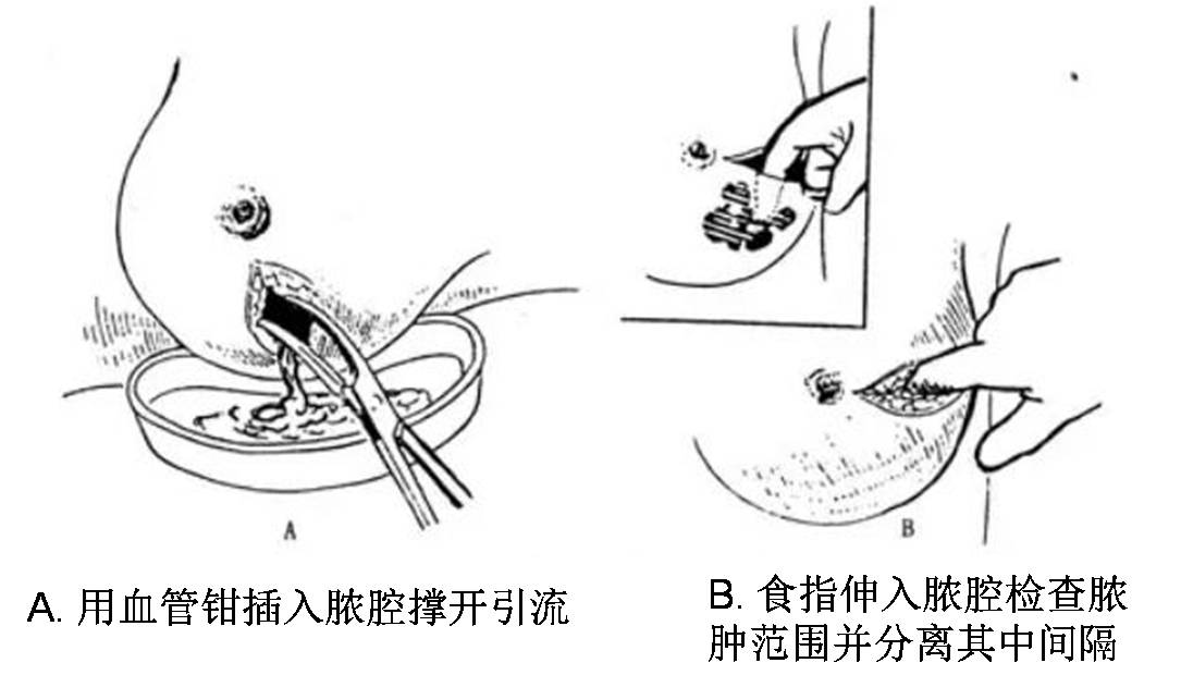乳房脓切开引流.png