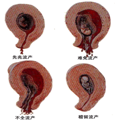 流产的临床类型及表现.png