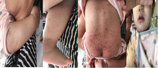 入院第一天Cox A6手足口病患者皮疹1.png