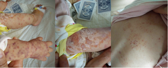 入院第四天Cox A6手足口病患者皮疹1.png