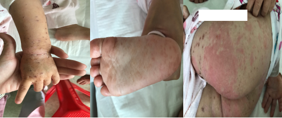 入院第六天Cox A6手足口病患者皮疹1.png